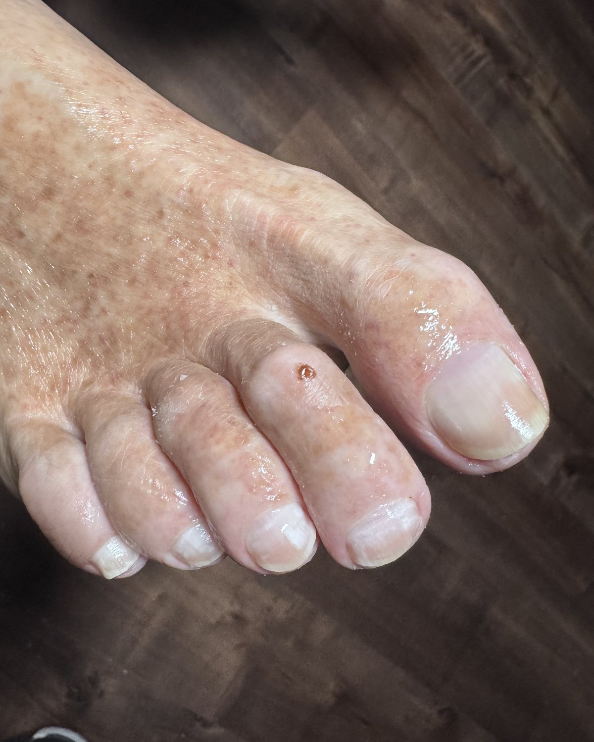 Toenails shaped and filed during a medical pedicure