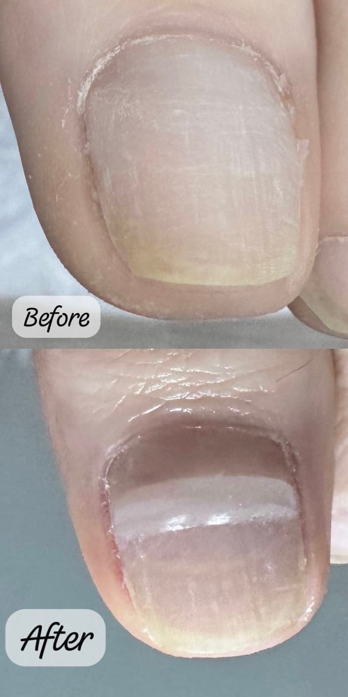 Before and after toenail reconstruction on a big toe, with the damaged nail surface rebuilt and smoothed